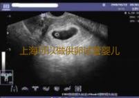 上海可以做供卵试管婴儿的医院有哪些-去试管代怀机构