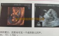 深圳有哪些供卵不排队深圳试管婴儿移植后需要注意哪些问题‘男孕囊和女孕囊的区别’